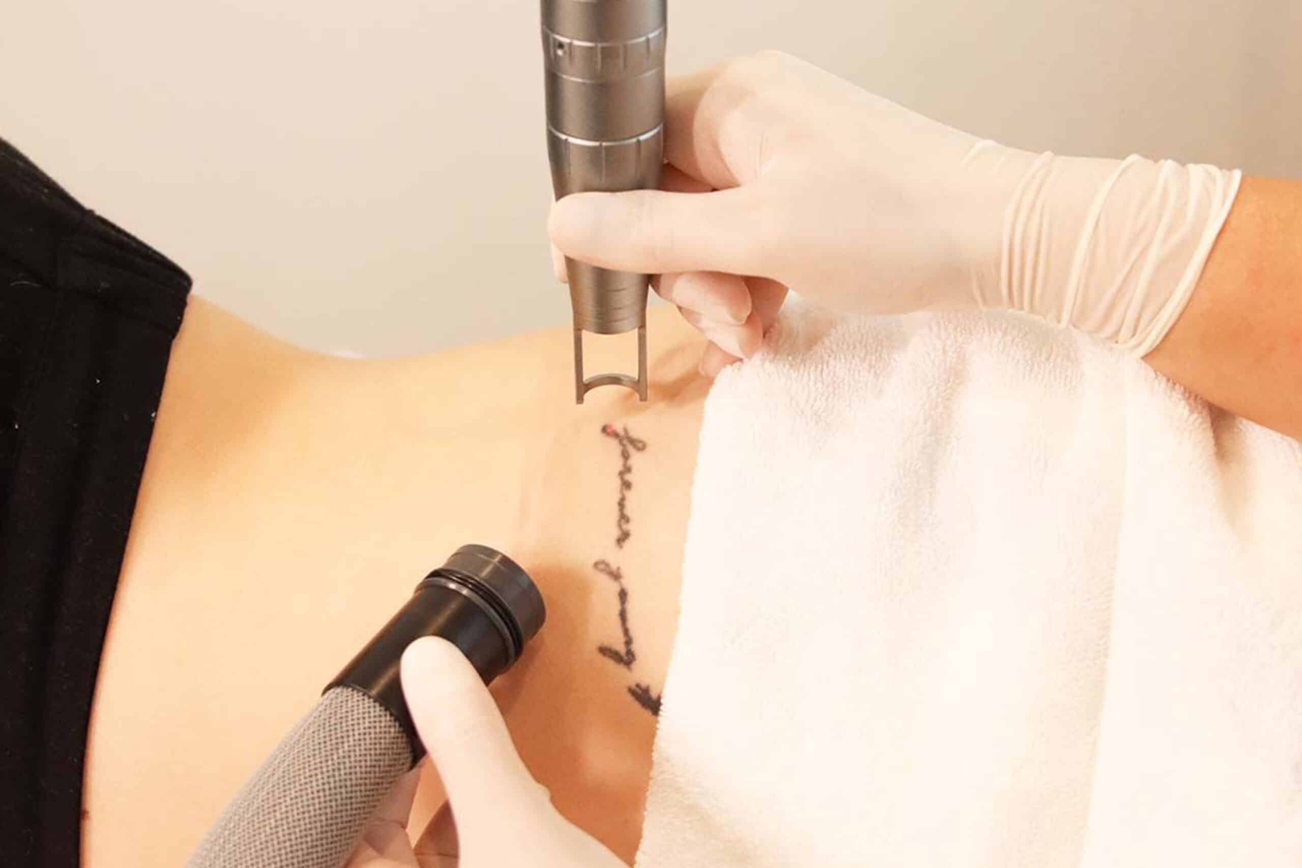 Image of Tattoo Removal