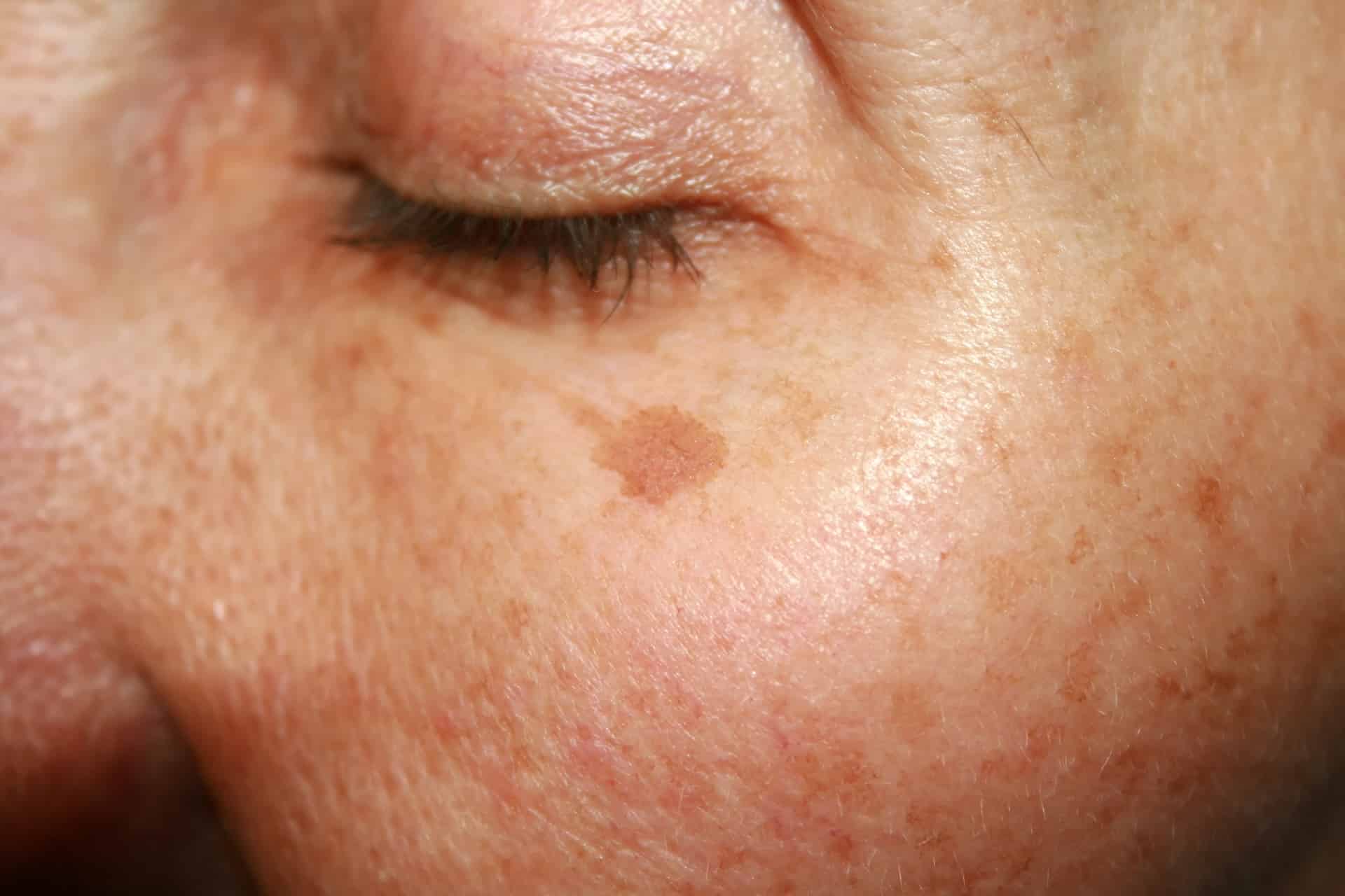 Image of Hyperpigmentation & Sun Damage