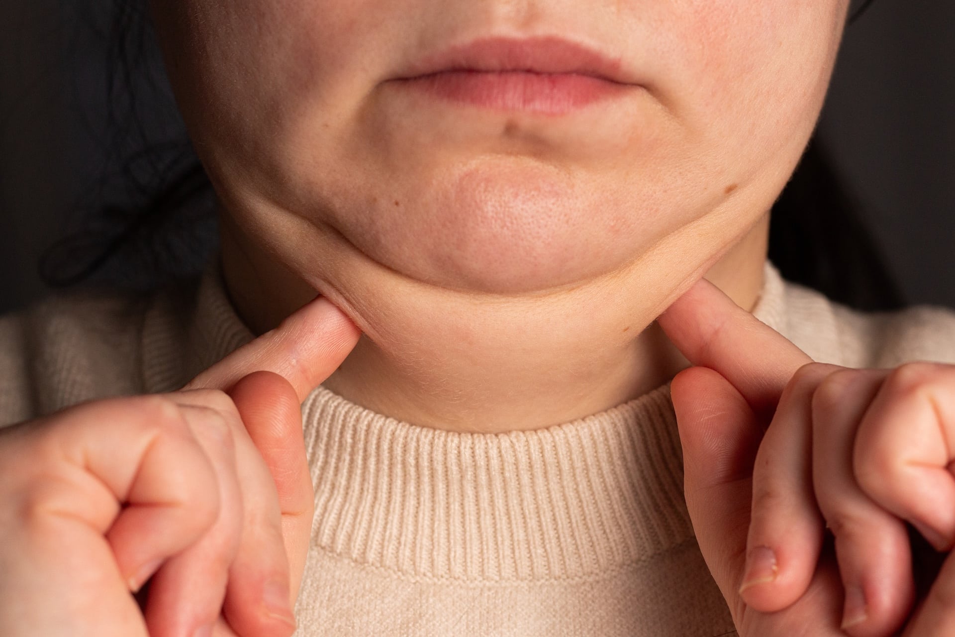 Image of Double Chin (Submental Fullness)